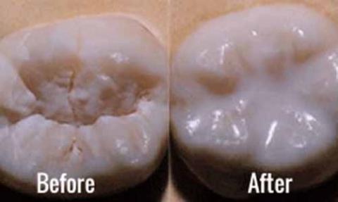 sealants